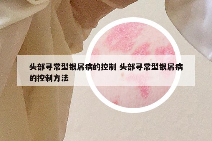 头部寻常型银屑病的控制 头部寻常型银屑病的控制方法