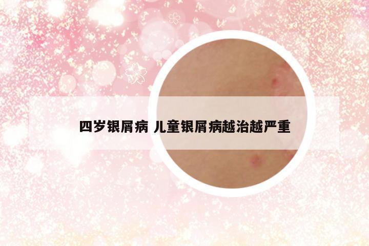 四岁银屑病 儿童银屑病越治越严重