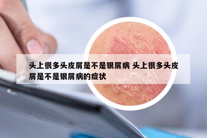 头上很多头皮屑是不是银屑病 头上很多头皮屑是不是银屑病的症状