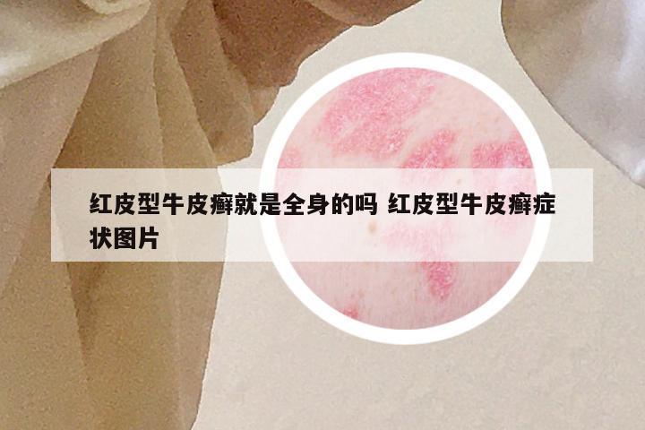 红皮型牛皮癣就是全身的吗 红皮型牛皮癣症状图片
