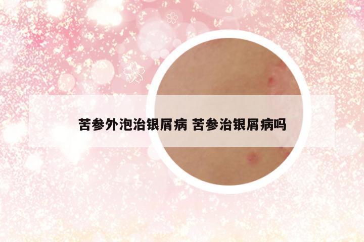 苦参外泡治银屑病 苦参治银屑病吗