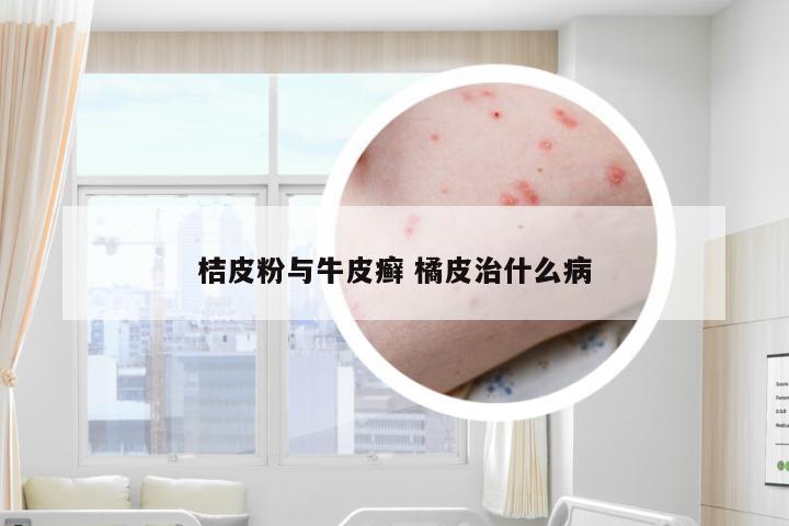 桔皮粉与牛皮癣 橘皮治什么病