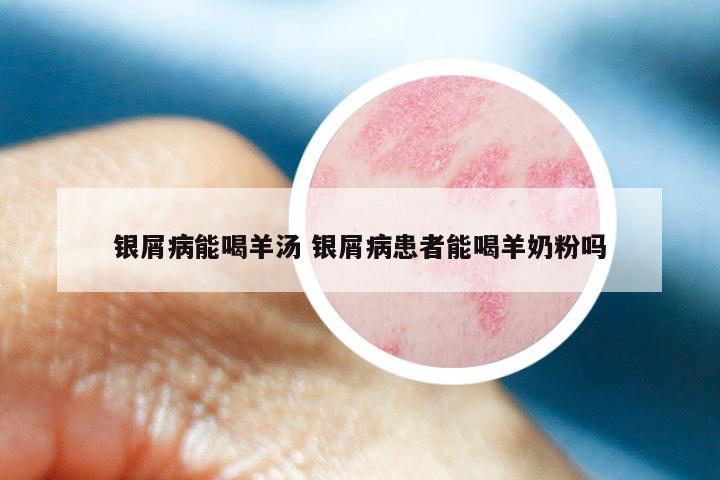 银屑病能喝羊汤 银屑病患者能喝羊奶粉吗