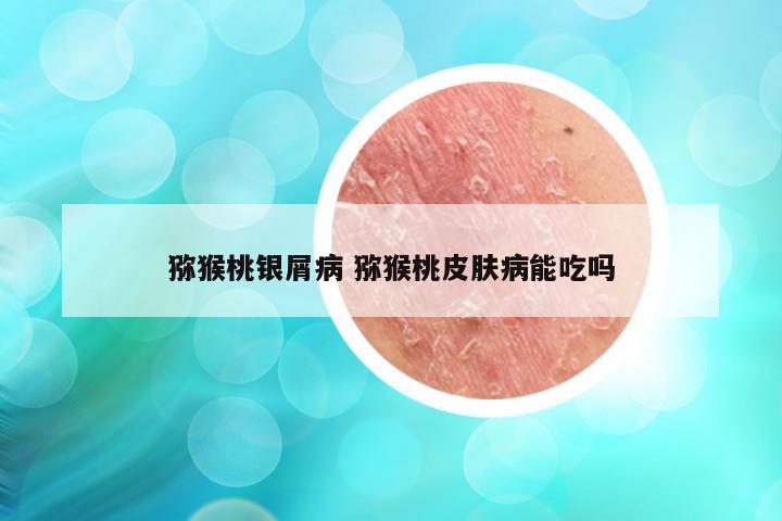 猕猴桃银屑病 猕猴桃皮肤病能吃吗