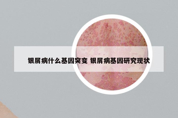 银屑病什么基因突变 银屑病基因研究现状