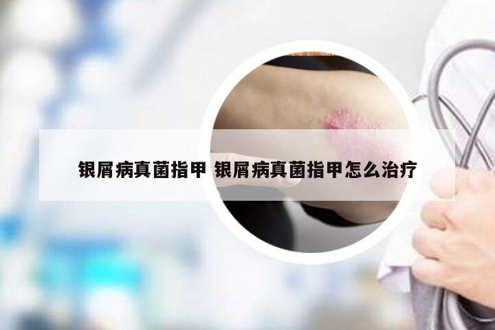 银屑病真菌指甲 银屑病真菌指甲怎么治疗