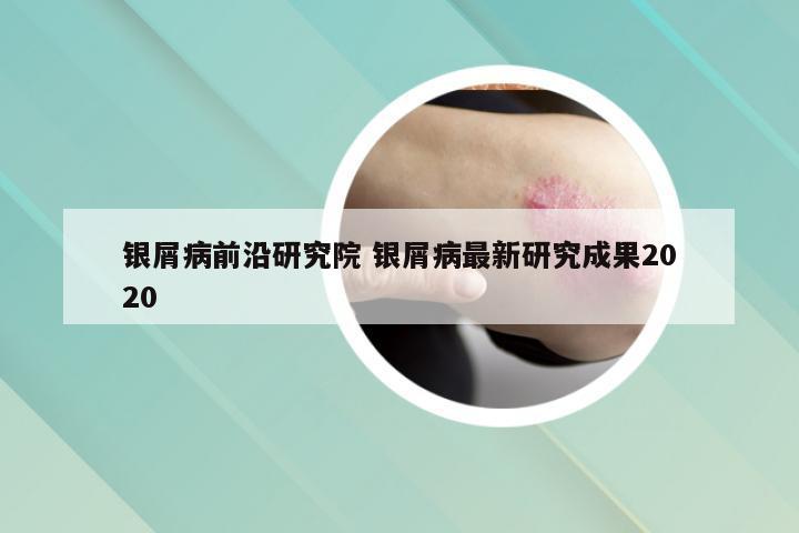 银屑病前沿研究院 银屑病最新研究成果2020
