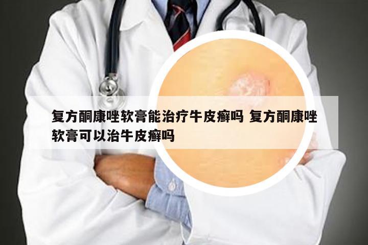 复方酮康唑软膏能治疗牛皮癣吗 复方酮康唑软膏可以治牛皮癣吗