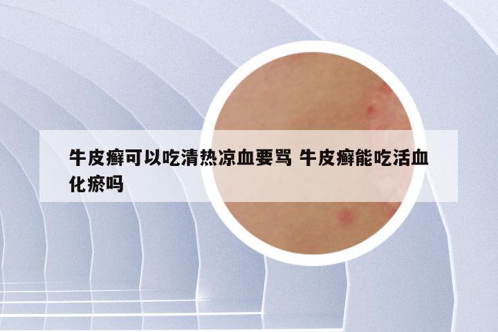 牛皮癣可以吃清热凉血要骂 牛皮癣能吃活血化瘀吗
