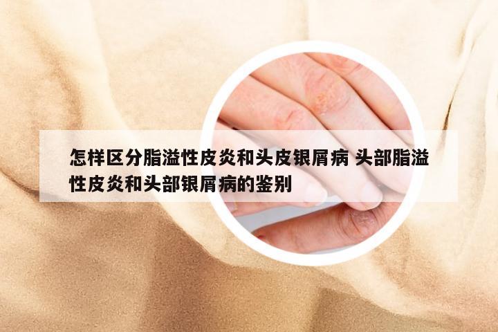 怎样区分脂溢性皮炎和头皮银屑病 头部脂溢性皮炎和头部银屑病的鉴别