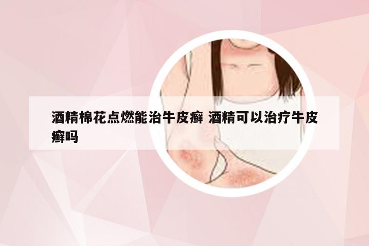 酒精棉花点燃能治牛皮癣 酒精可以治疗牛皮癣吗