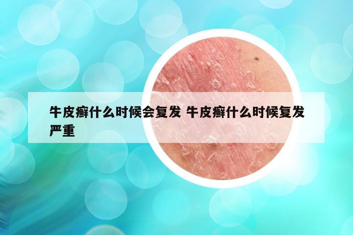牛皮癣什么时候会复发 牛皮癣什么时候复发严重