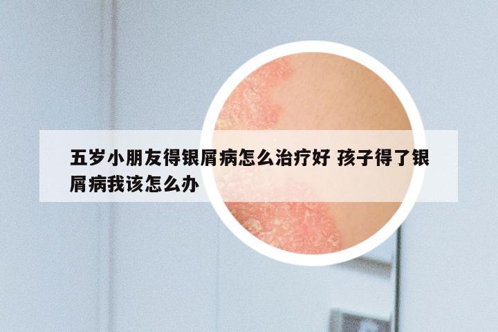 五岁小朋友得银屑病怎么治疗好 孩子得了银屑病我该怎么办