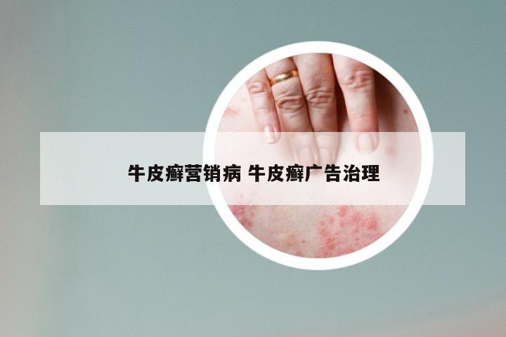 牛皮癣营销病 牛皮癣广告治理