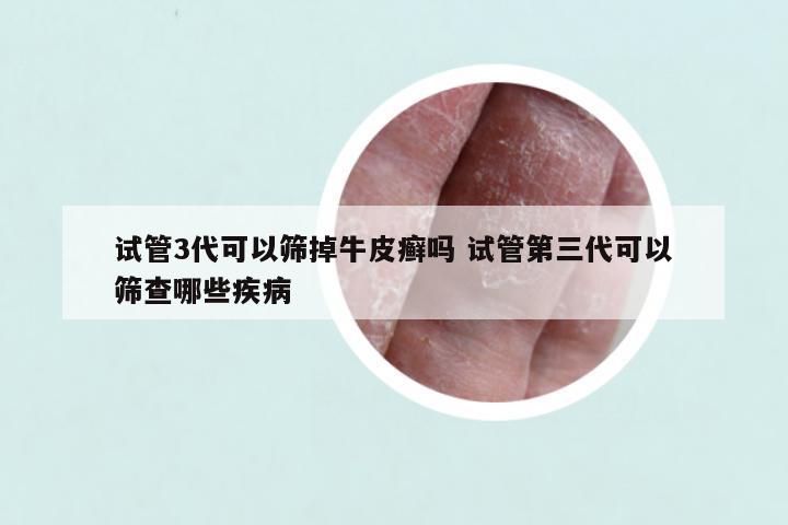 试管3代可以筛掉牛皮癣吗 试管第三代可以筛查哪些疾病