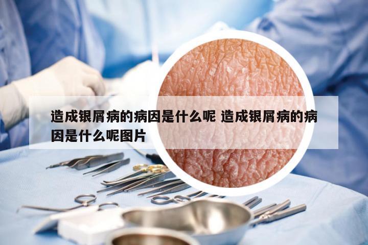 造成银屑病的病因是什么呢 造成银屑病的病因是什么呢图片
