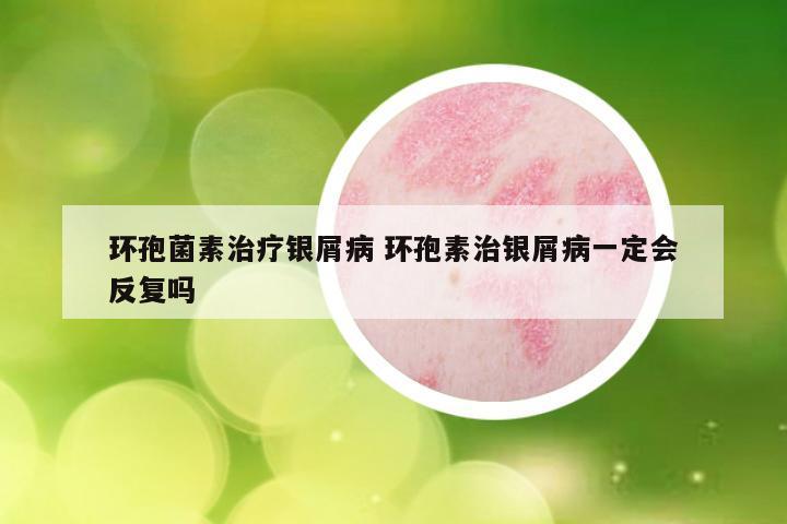 环孢菌素治疗银屑病 环孢素治银屑病一定会反复吗