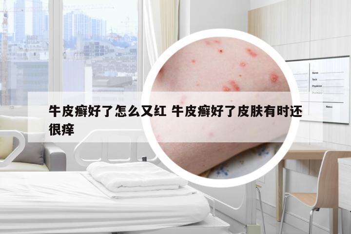 牛皮癣好了怎么又红 牛皮癣好了皮肤有时还很痒