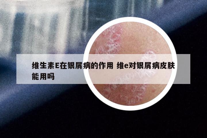 维生素E在银屑病的作用 维e对银屑病皮肤能用吗