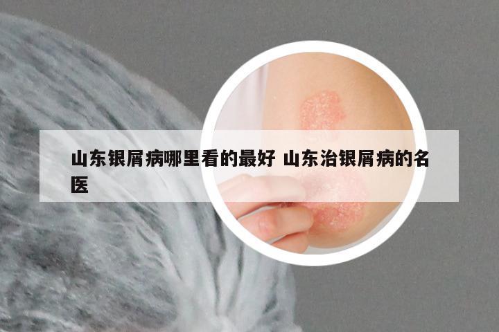 山东银屑病哪里看的最好 山东治银屑病的名医