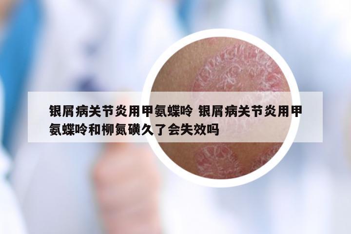 银屑病关节炎用甲氨蝶呤 银屑病关节炎用甲氨蝶呤和柳氮磺久了会失效吗