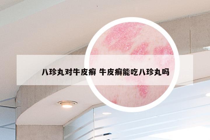 八珍丸对牛皮癣 牛皮癣能吃八珍丸吗