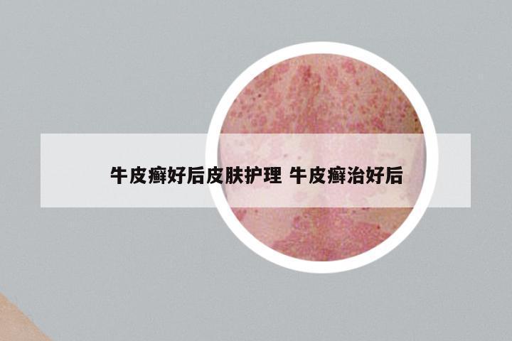 牛皮癣好后皮肤护理 牛皮癣治好后