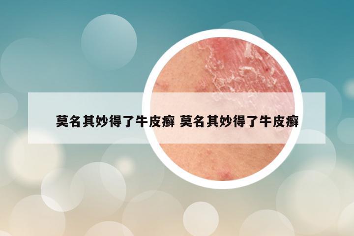 莫名其妙得了牛皮癣 莫名其妙得了牛皮癣