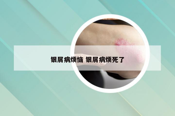 银屑病烦恼 银屑病烦死了