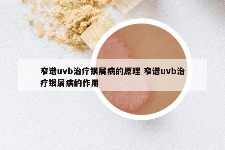 窄谱uvb治疗银屑病的原理 窄谱uvb治疗银屑病的作用