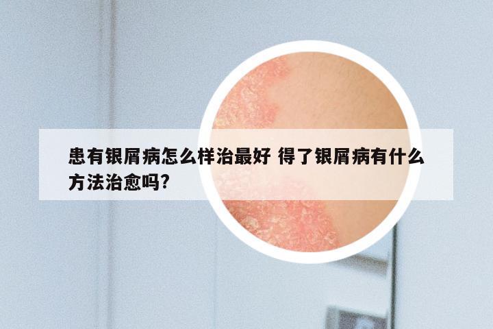 患有银屑病怎么样治最好 得了银屑病有什么方法治愈吗?