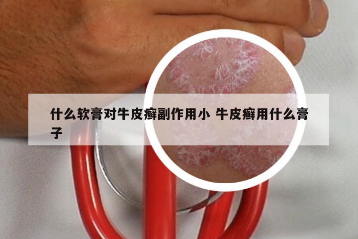 什么软膏对牛皮癣副作用小 牛皮癣用什么膏子