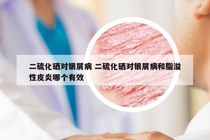 二硫化硒对银屑病 二硫化硒对银屑病和脂溢性皮炎哪个有效