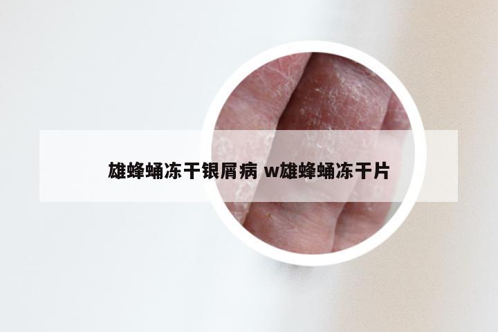 雄蜂蛹冻干银屑病 w雄蜂蛹冻干片