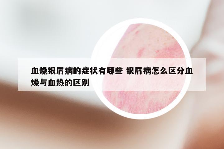 血燥银屑病的症状有哪些 银屑病怎么区分血燥与血热的区别