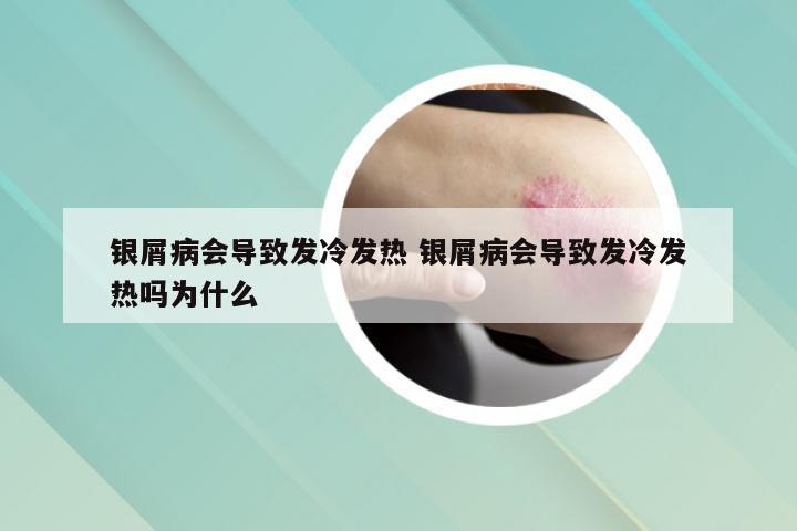 银屑病会导致发冷发热 银屑病会导致发冷发热吗为什么