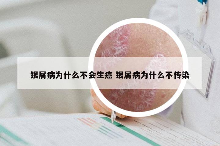 银屑病为什么不会生癌 银屑病为什么不传染