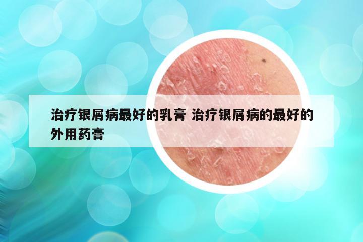 治疗银屑病最好的乳膏 治疗银屑病的最好的外用药膏