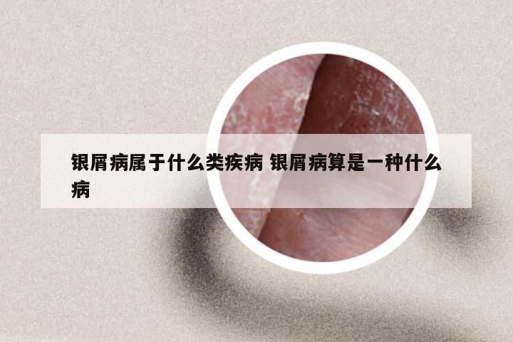 银屑病属于什么类疾病 银屑病算是一种什么病