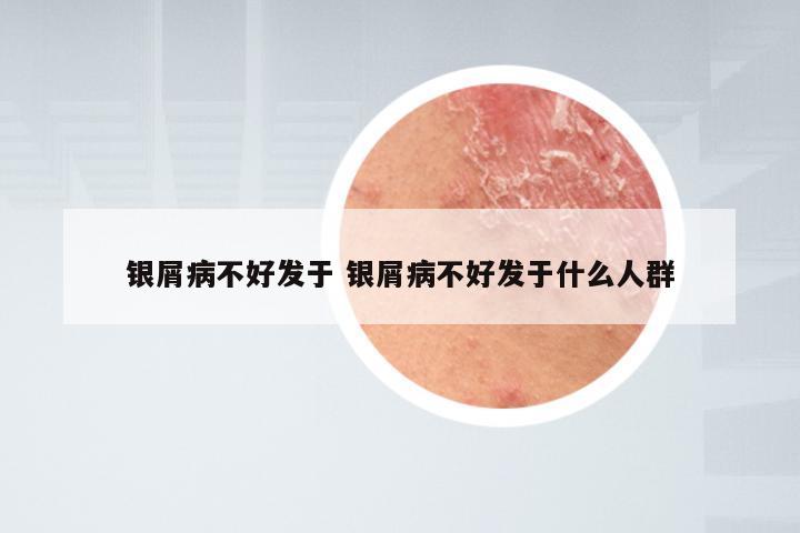 银屑病不好发于 银屑病不好发于什么人群