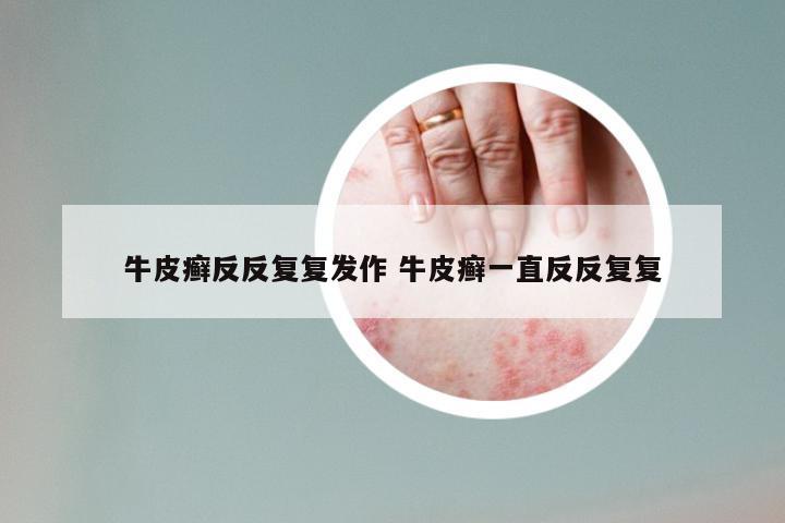 牛皮癣反反复复发作 牛皮癣一直反反复复