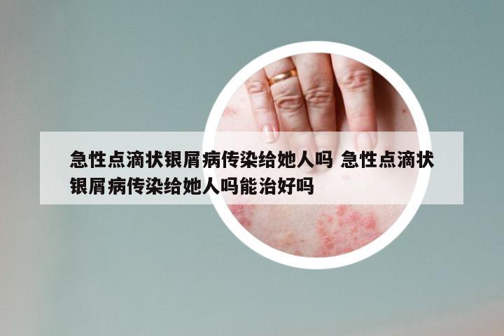 急性点滴状银屑病传染给她人吗 急性点滴状银屑病传染给她人吗能治好吗