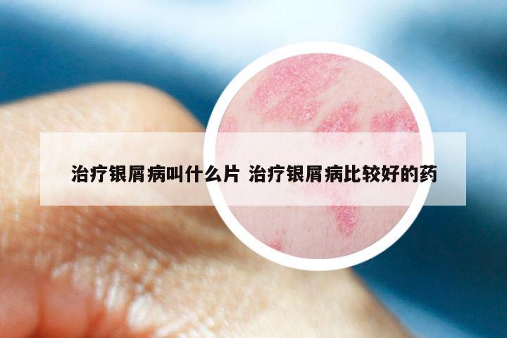 治疗银屑病叫什么片 治疗银屑病比较好的药