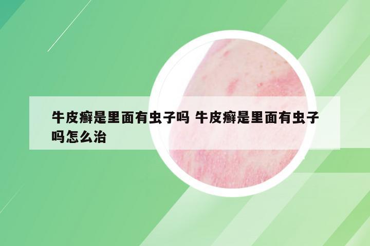 牛皮癣是里面有虫子吗 牛皮癣是里面有虫子吗怎么治