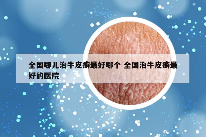 全国哪儿治牛皮癣最好哪个 全国治牛皮癣最好的医院