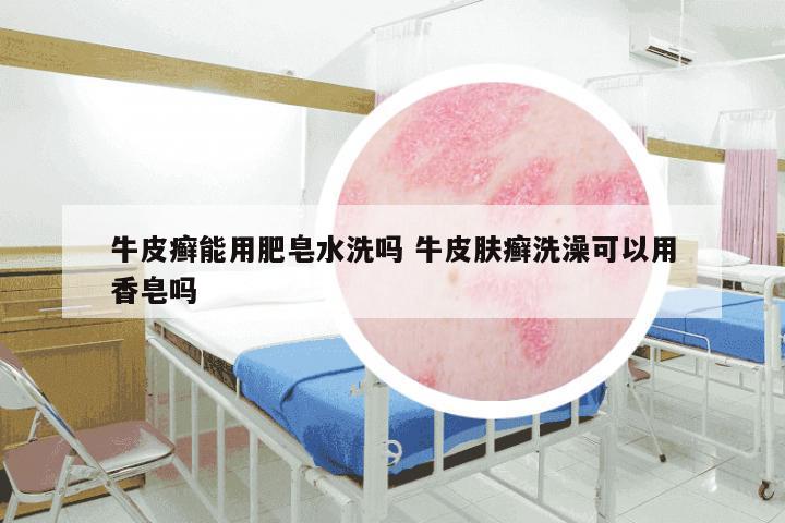 牛皮癣能用肥皂水洗吗 牛皮肤癣洗澡可以用香皂吗
