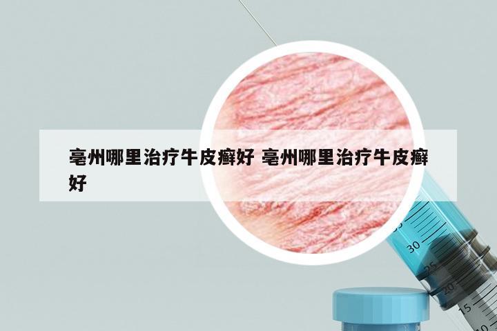 亳州哪里治疗牛皮癣好 亳州哪里治疗牛皮癣好
