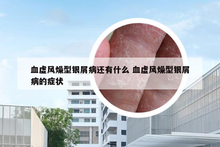 血虚风燥型银屑病还有什么 血虚风燥型银屑病的症状