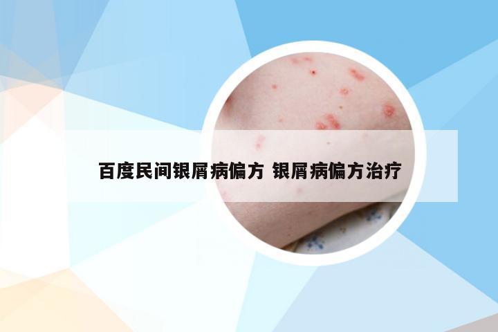 百度民间银屑病偏方 银屑病偏方治疗