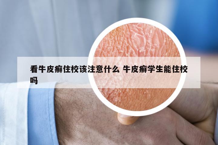看牛皮癣住校该注意什么 牛皮癣学生能住校吗